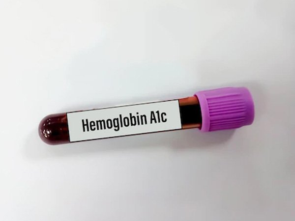 A1C- testing for confirmation of diabetes