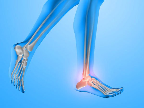 Complications of Neuropathy