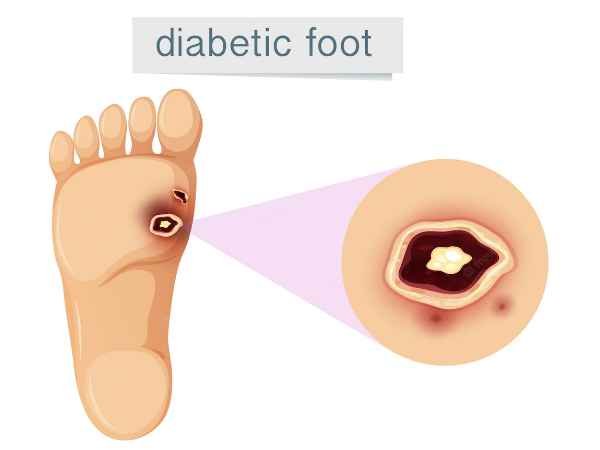 Diabetic Foot Treat It Before It's Too Late