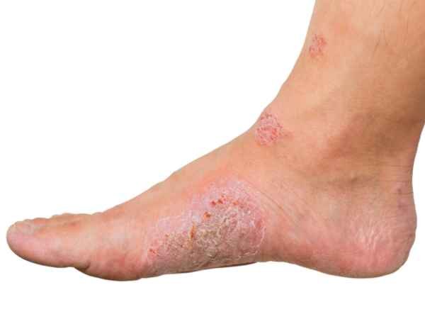 Understanding Diabetic Foot Diagnosis, Causes, Treatments, Preventions.