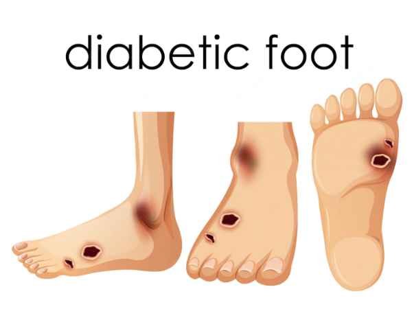 What is the diabetic foot